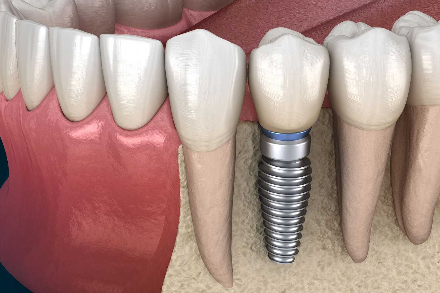 Why is implant survival important and what guarantees are provided?